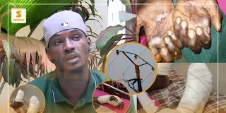 Amputé d’une jambe après avoir été électrocuté, Issa Ndiaye raconte son calvaire (Senego-TV)